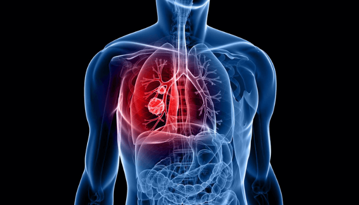 Lung cancer