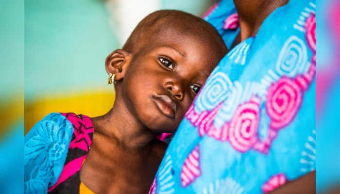 Child malnutrition in Nigeria