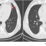 Giant Cell Arteritis