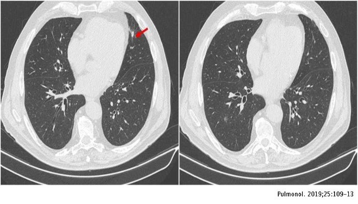 Giant Cell Arteritis
