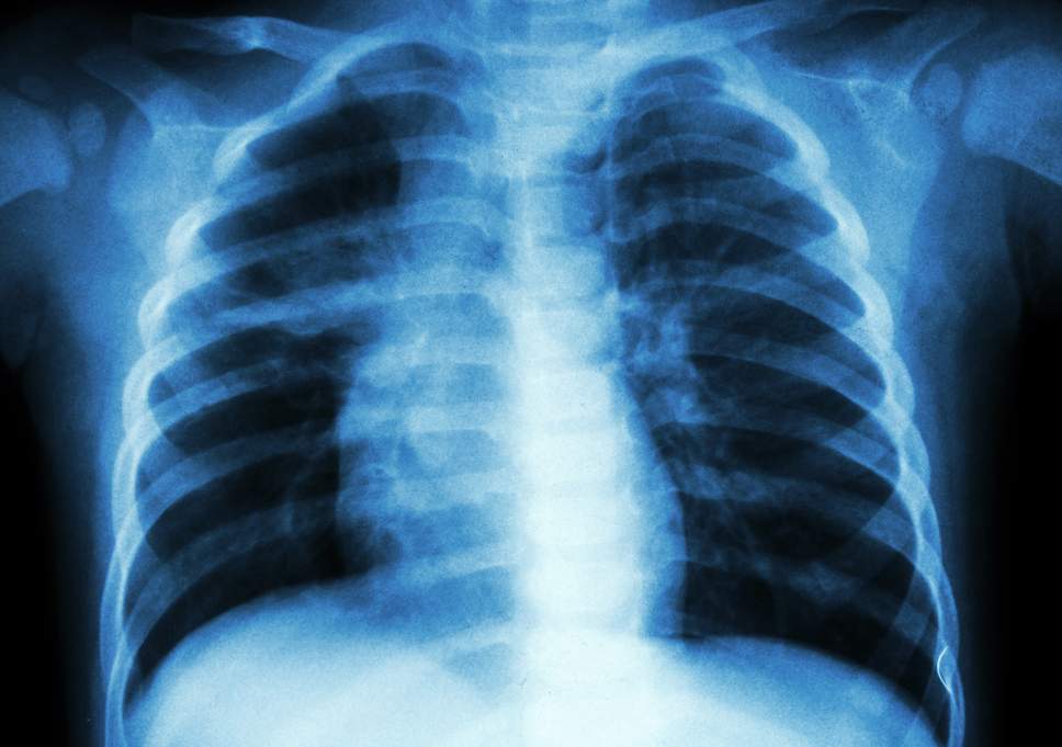 Tuberculosis