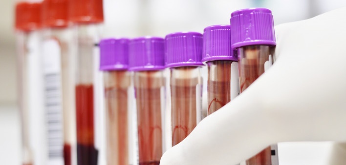 Diagnostic tests for tuberculosis, hepatitis, HPV included in global access program- Roche