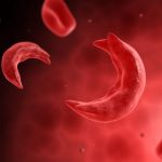 Experts urge focus on quality healthcare for sickle cell carriers in Nigeria
