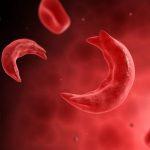 sickle cell anaemia