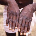 Monkey Pox: Lagos alerts public to precautionary measures