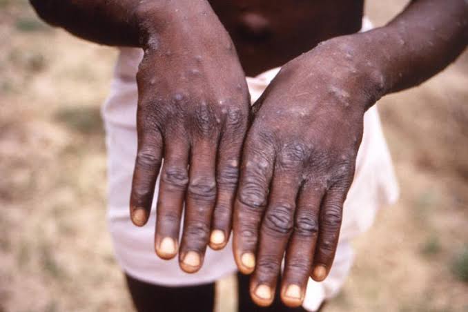 Monkey Pox: Lagos alerts public to precautionary measures