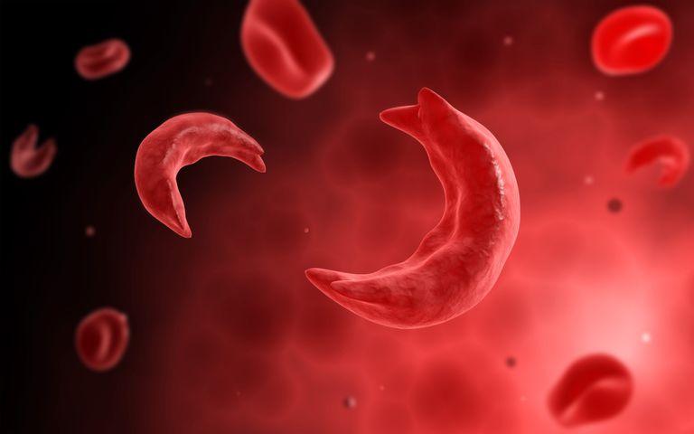 Expert urges Nigeria Govt to upgrade sickle cell facilities in public hospitals