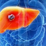Liver Cancer