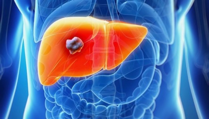 Liver Cancer