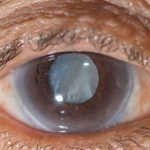 Inlaks, others sponsor cataract surgeries for Nigerians