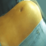 How non-invasive technologies can improve treatment of fibroid