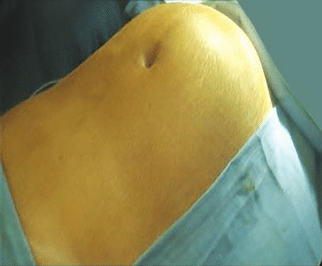 How non-invasive technologies can improve treatment of fibroid