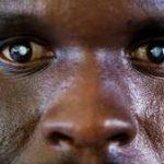 Neglected Tropical Diseases