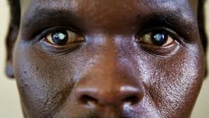 Neglected Tropical Diseases