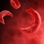 Sickle Cell