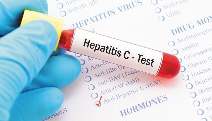 Hepatitis Test