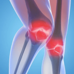 Arthritis