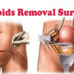 fibroid treatment