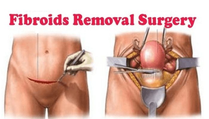 fibroid treatment