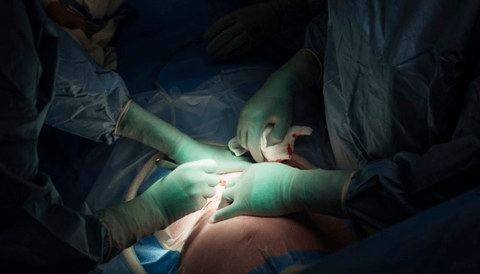 Cesarean Deliveries