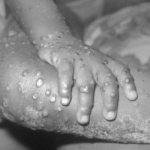monkeypox