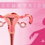 endometriosis