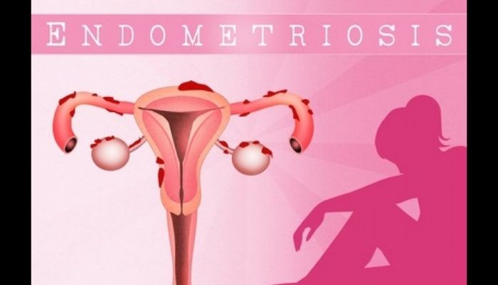 endometriosis