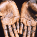Monkeypox cases in Nigeria