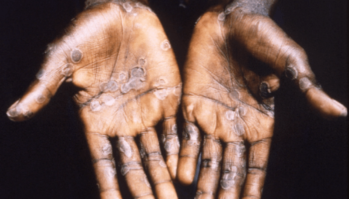 Monkeypox cases in Nigeria