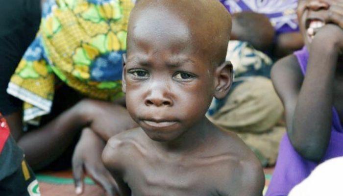 malnutrition in Nigeria