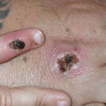 Monkeypox