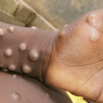 Monkeypox