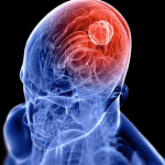 brain tumor