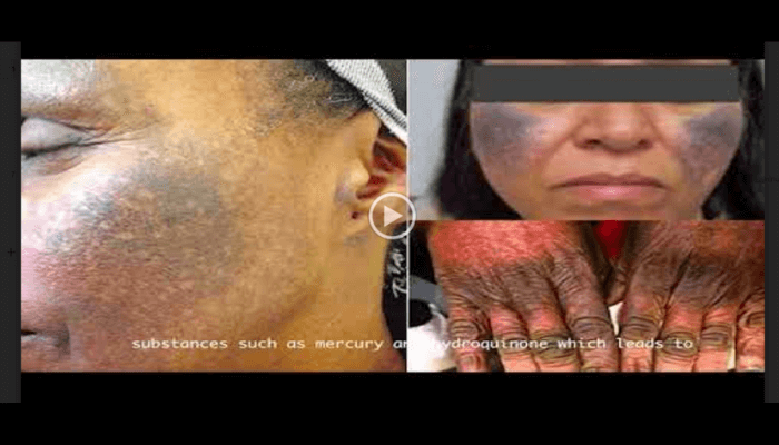 Fair skin at the cost of people’s health