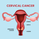 cervical cancer