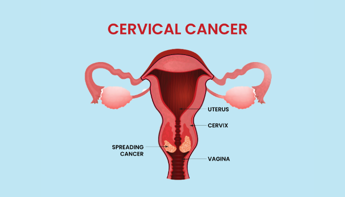 cervical cancer