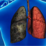 We partner IHV to reduce prevalence of tuberculosis in Ogun - OGSG