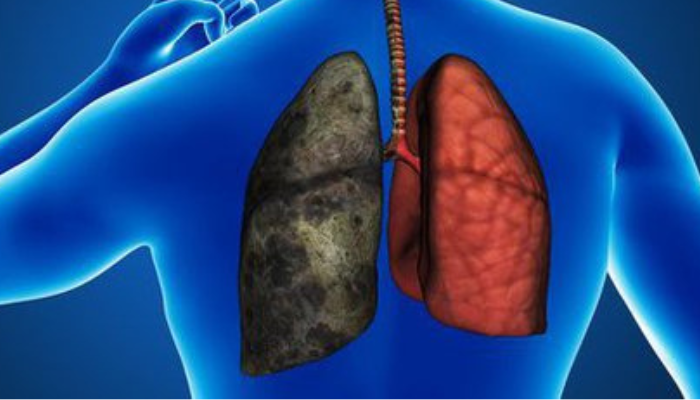 We partner IHV to reduce prevalence of tuberculosis in Ogun - OGSG