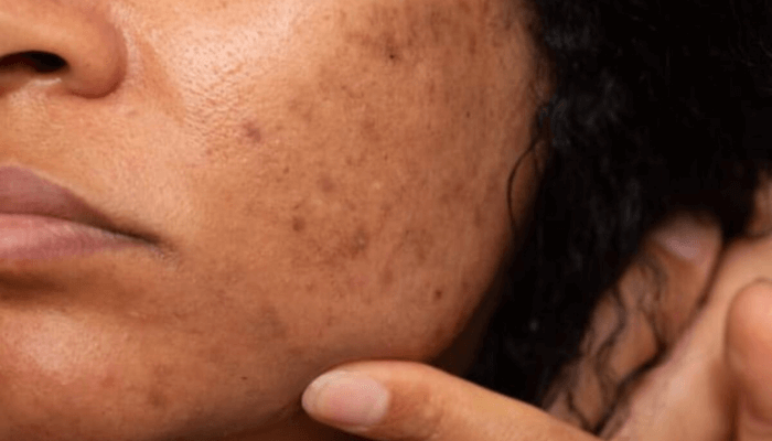 Hyperpigmentation